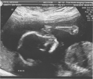 Baby Frye Ultrasound