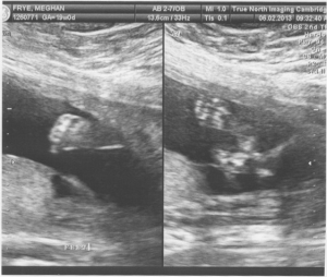 Baby Frye Ultrasound